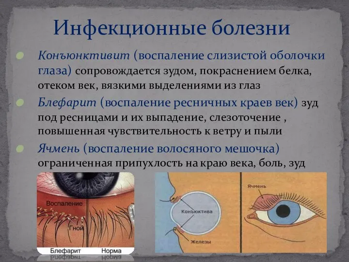 Инфекционные болезни Конъюнктивит (воспаление слизистой оболочки глаза) сопровождается зудом, покраснением белка,