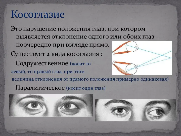 Это нарушение положения глаз, при котором выявляется отклонение одного или обоих