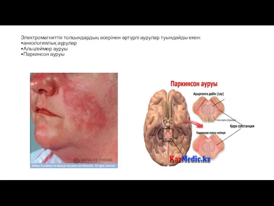 Электромагниттік толқындардың әсерінен әртүрлі аурулар туындайды екен: •анкологиялық аурулар •Альцгеймер ауруы •Паркинсон ауруы