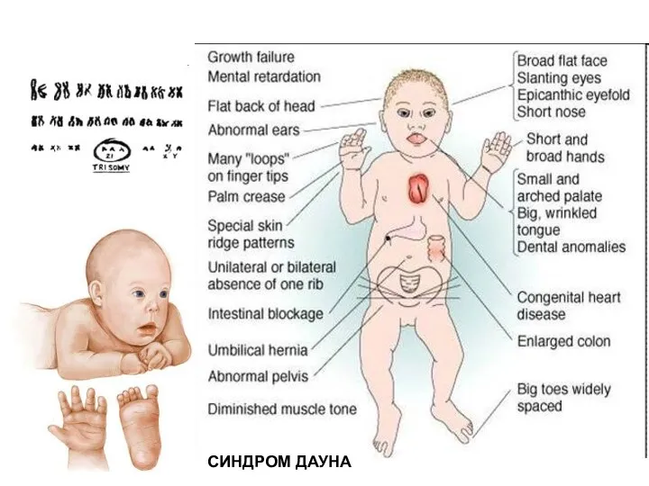 СИНДРОМ ДАУНА