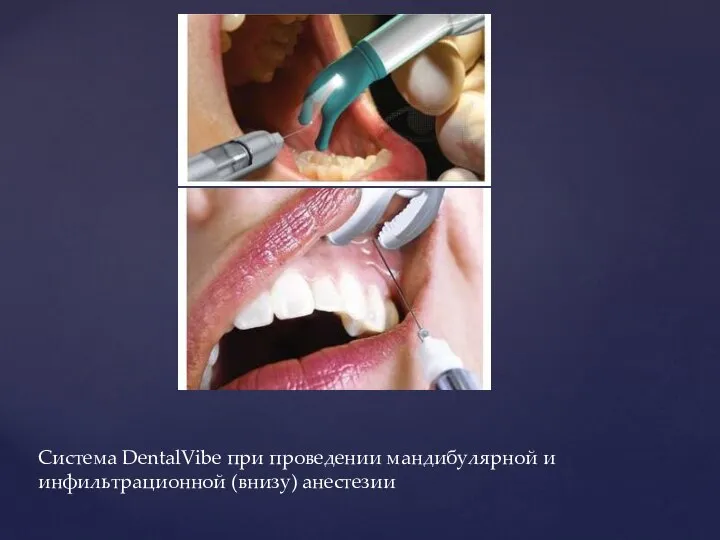 Система DentalVibe при проведении мандибулярной и инфильтрационной (внизу) анестезии