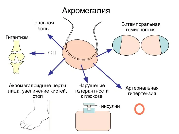 Акромегалия Головная боль Битемпоральная гемианопсия Артериальная гипертензия Нарушение толерантности к глюкозе