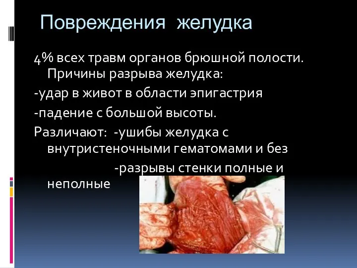 Повреждения желудка 4% всех травм органов брюшной полости.Причины разрыва желудка: -удар