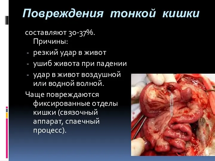 Повреждения тонкой кишки составляют 30-37%.Причины: резкий удар в живот ушиб живота