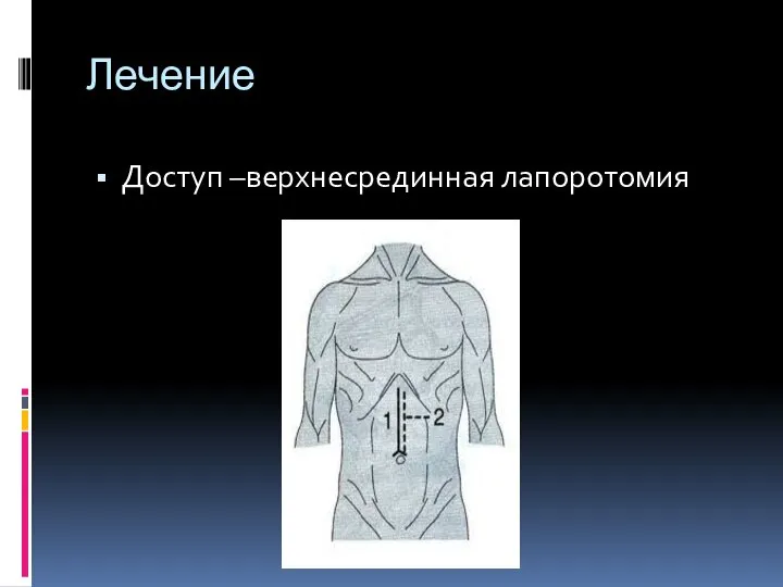 Лечение Доступ –верхнесрединная лапоротомия