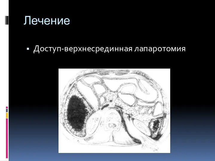 Лечение Доступ-верхнесрединная лапаротомия