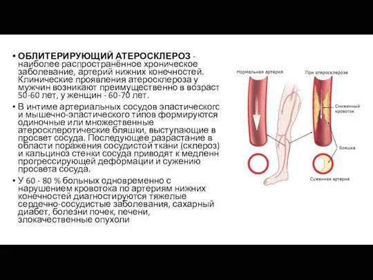 ОБЛИТЕРИРУЮЩИЙ АТЕРОСКЛЕРОЗ - наиболее распространённое хроническое заболевание, артерий нижних конечностей. Клинические