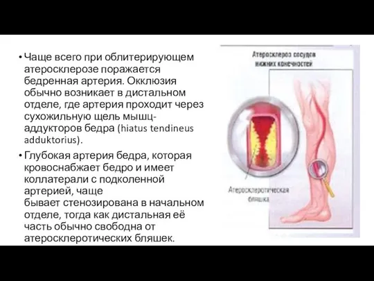 Чаще всего при облитерирующем атеросклерозе поражается бедренная артерия. Окклюзия обычно возникает