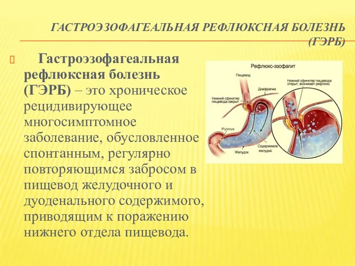 ГАСТРОЭЗОФАГЕАЛЬНАЯ РЕФЛЮКСНАЯ БОЛЕЗНЬ (ГЭРБ) Гастроэзофагеальная рефлюксная болезнь (ГЭРБ) – это хроническое