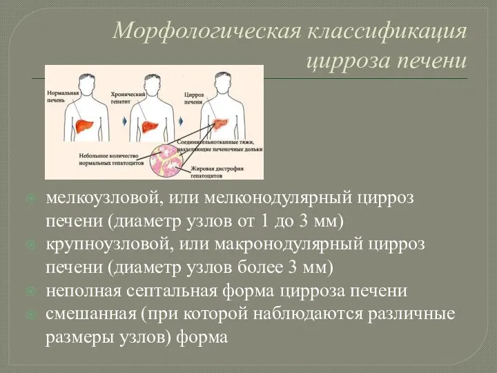 Морфологическая классификация цирроза печени мелкоузловой, или мелконодулярный цирроз печени (диаметр узлов