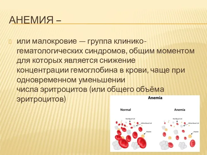 АНЕМИЯ – или малокровие — группа клинико-гематологических синдромов, общим моментом для