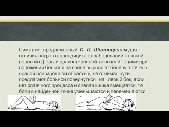 Симптом, предложенный С. П. Шиловцевым для отличия острого аппендицита от заболеваний