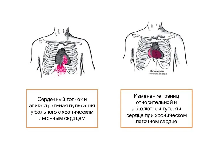 Изменение границ относительной и абсолютной тупости сердца при хроническом легочном сердце