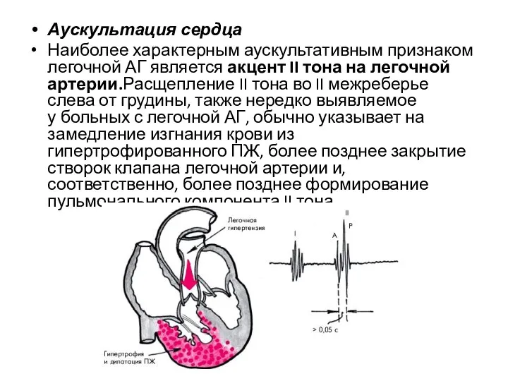 Аускультация сердца Наиболее характерным аускультативным признаком легочной АГ является акцент II