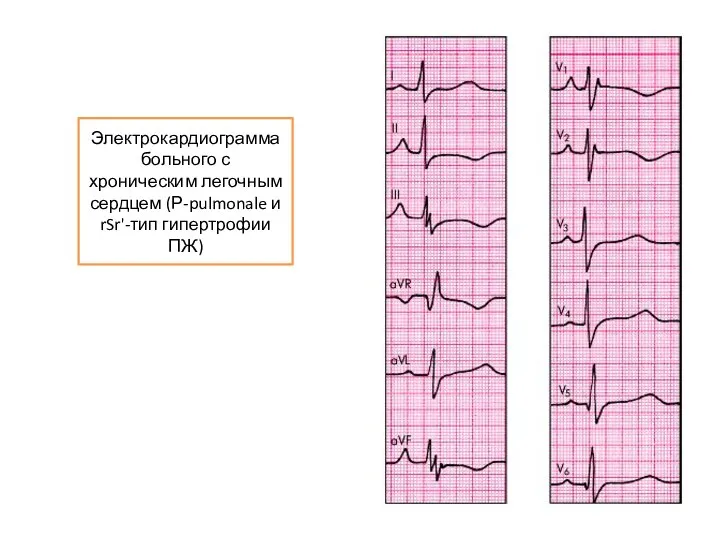 Электрокардиограмма больного с хроническим легочным сердцем (Р-pulmonale и rSr'-тип гипертрофии ПЖ)