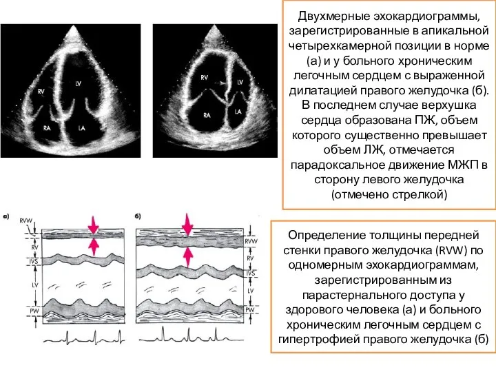 Двухмерные эхокардиограммы, зарегистрированные в апикальной четырехкамерной позиции в норме (а) и