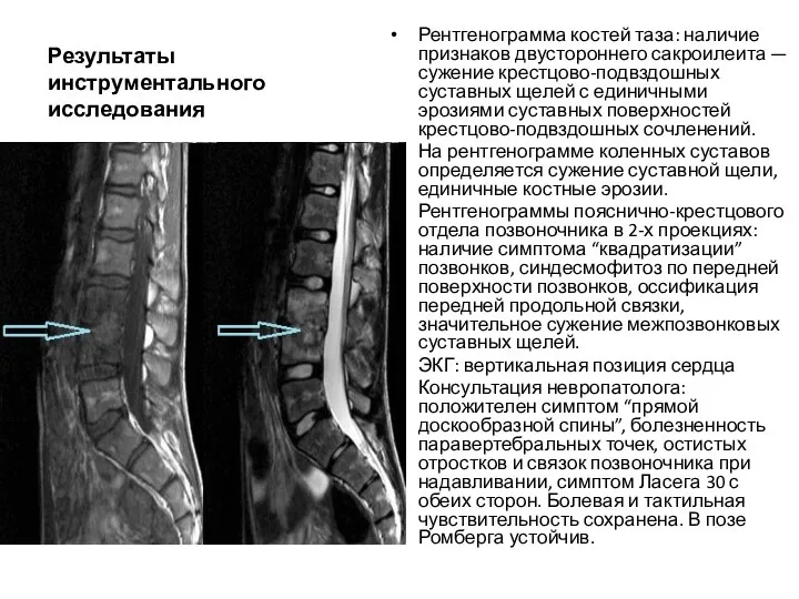 Результаты инструментального исследования Рентгенограмма костей таза: наличие признаков двустороннего сакроилеита —