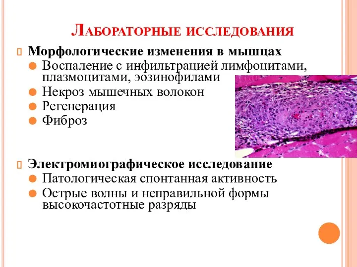 Лабораторные исследования Морфологические изменения в мышцах Воспаление с инфильтрацией лимфоцитами, плазмоцитами,