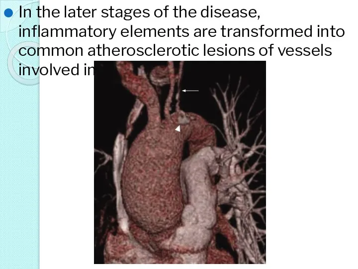 In the later stages of the disease, inflammatory elements are transformed