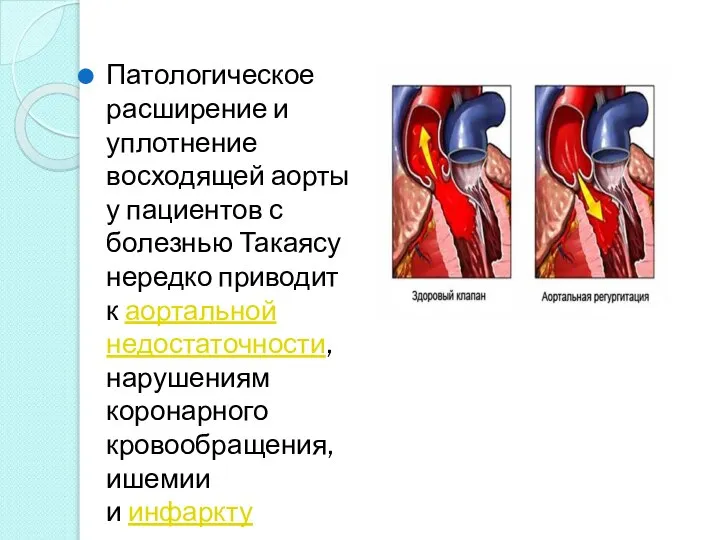 Патологическое расширение и уплотнение восходящей аорты у пациентов с болезнью Такаясу