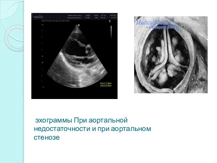 эхограммы При аортальной недостаточности и при аортальном стенозе