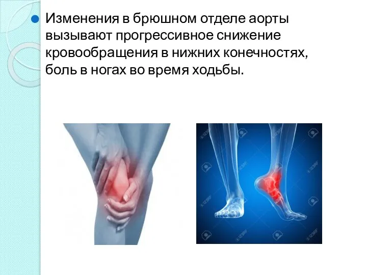 Изменения в брюшном отделе аорты вызывают прогрессивное снижение кровообращения в нижних