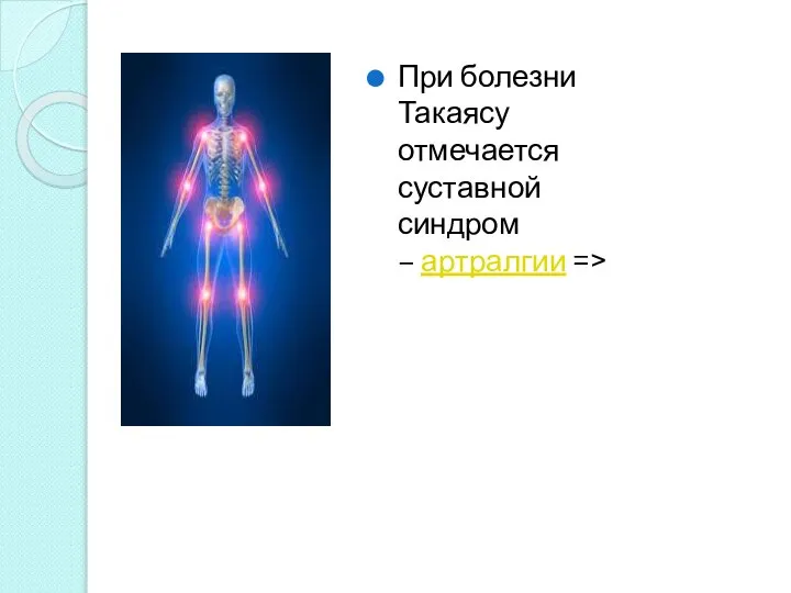 При болезни Такаясу отмечается суставной синдром – артралгии =>