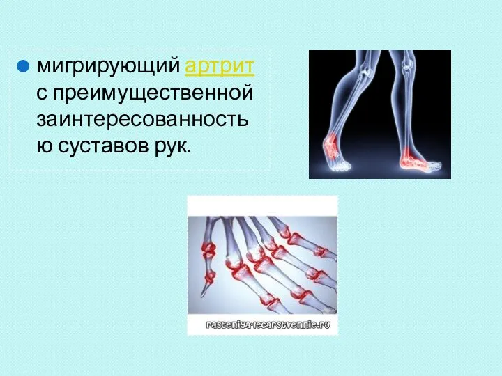 мигрирующий артрит с преимущественной заинтересованностью суставов рук.