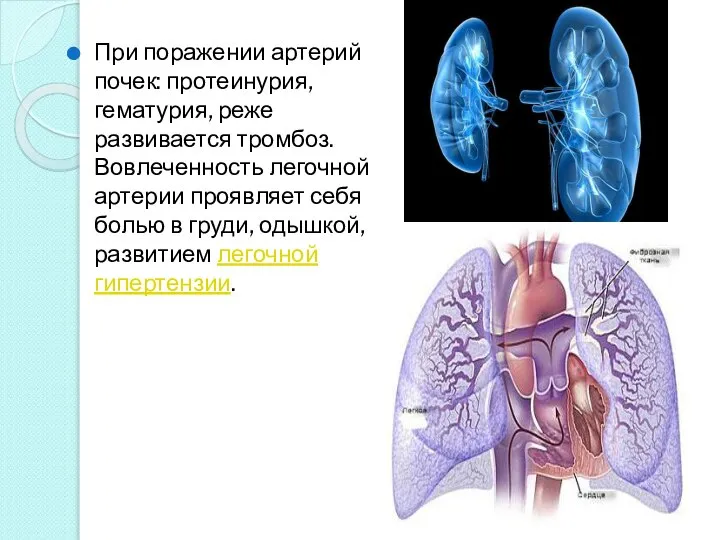 При поражении артерий почек: протеинурия, гематурия, реже развивается тромбоз. Вовлеченность легочной