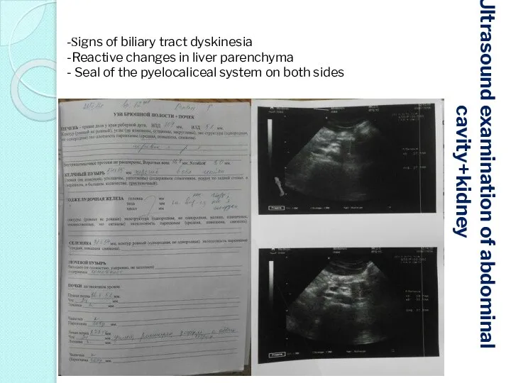 Ultrasound examination of abdominal cavity+kidney -Signs of biliary tract dyskinesia -Reactive