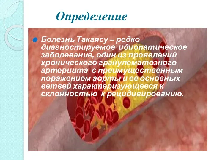 Определение Болезнь Такаясу – редко диагностируемое идиопатическое заболевание, один из проявлений