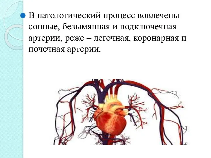 В патологический процесс вовлечены сонные, безымянная и подключечная артерии, реже – легочная, коронарная и почечная артерии.