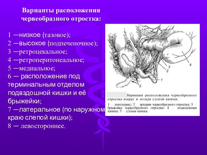 Варианты расположения червеобразного отростка: 1 —низкое (тазовое); 2 —высокое (подпеченочное); 3