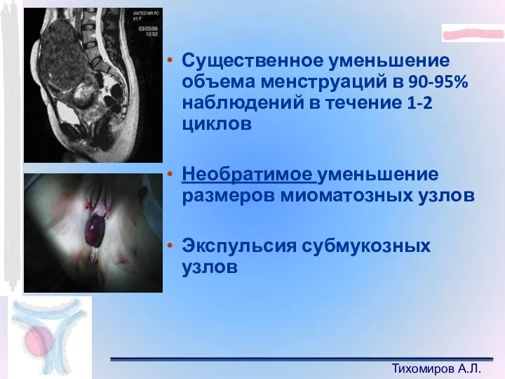 Тихомиров А.Л. Существенное уменьшение объема менструаций в 90-95% наблюдений в течение