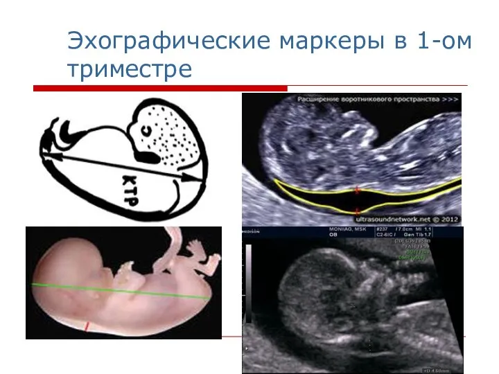 Эхографические маркеры в 1-ом триместре