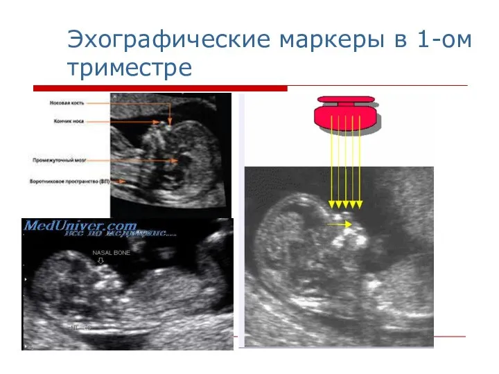 Эхографические маркеры в 1-ом триместре