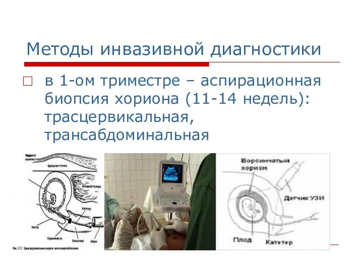 Методы инвазивной диагностики в 1-ом триместре – аспирационная биопсия хориона (11-14 недель): трасцервикальная, трансабдоминальная