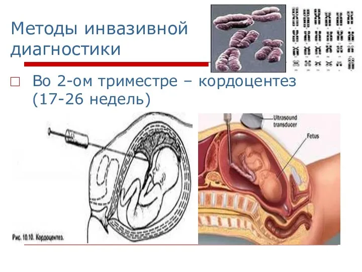 Методы инвазивной диагностики Во 2-ом триместре – кордоцентез (17-26 недель)