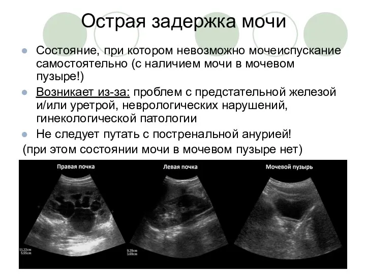 Острая задержка мочи Состояние, при котором невозможно мочеиспускание самостоятельно (с наличием