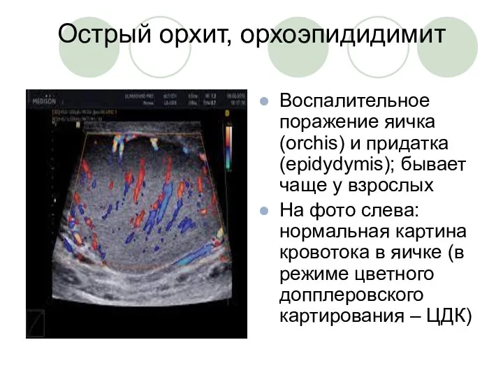 Острый орхит, орхоэпидидимит Воспалительное поражение яичка (orchis) и придатка (epidydymis); бывает