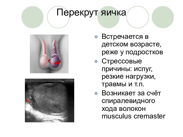 Перекрут яичка Встречается в детском возрасте, реже у подростков Стрессовые причины: