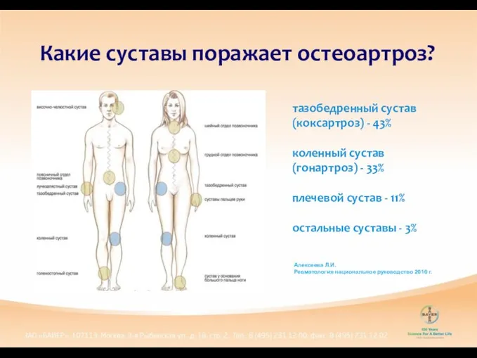 Какие суставы поражает остеоартроз? тазобедренный сустав (коксартроз) - 43% коленный сустав