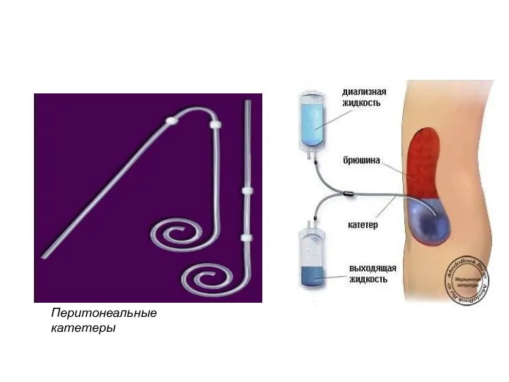 Перитонеальные катетеры