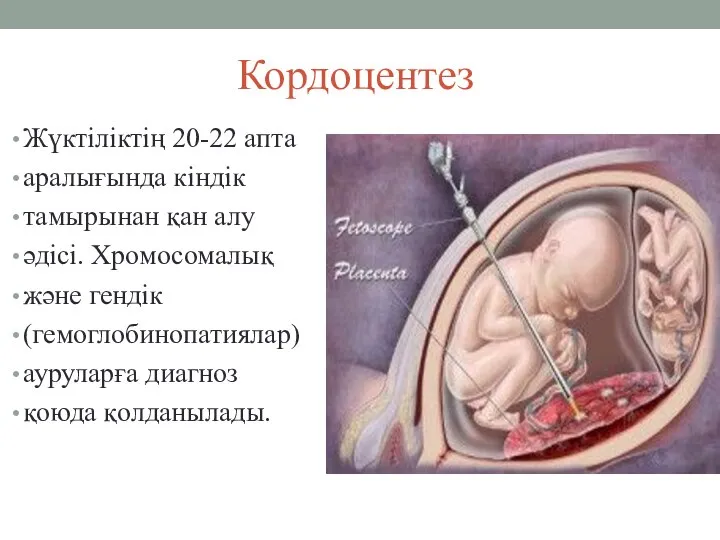 Кордоцентез Жүктіліктің 20-22 апта аралығында кіндік тамырынан қан алу әдісі. Хромосомалық