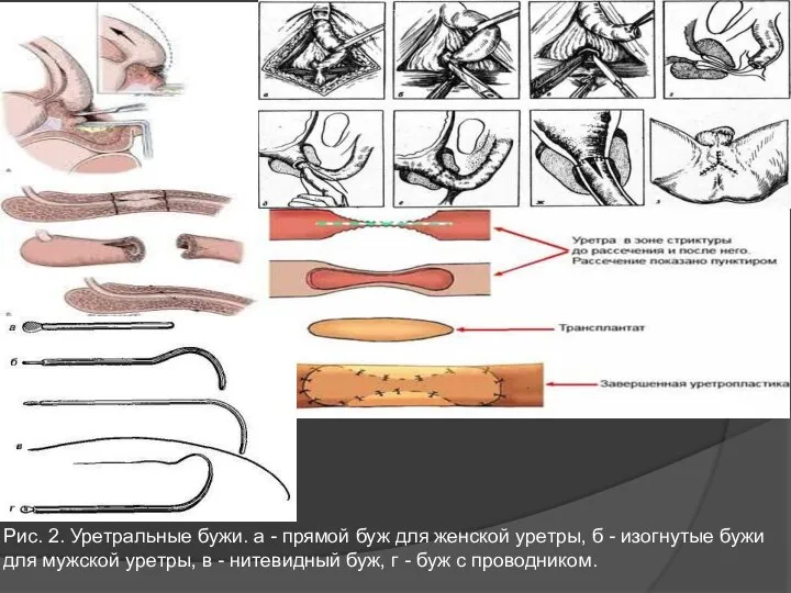 Рис. 2. Уретральные бужи. а - прямой буж для женской уретры,