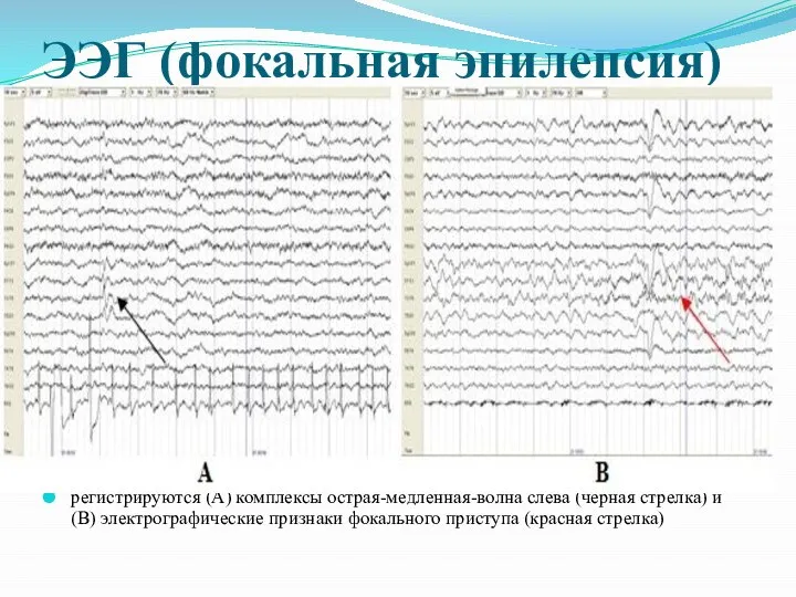 ЭЭГ (фокальная эпилепсия) регистрируются (A) комплексы острая-медленная-волна слева (черная стрелка) и