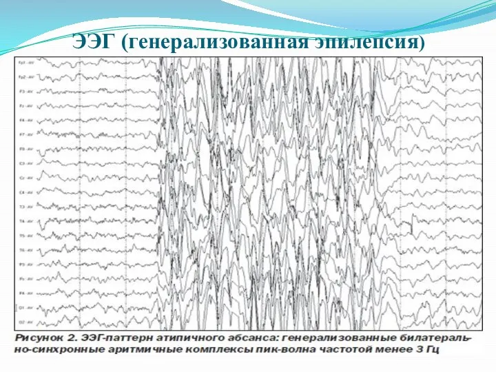 ЭЭГ (генерализованная эпилепсия)