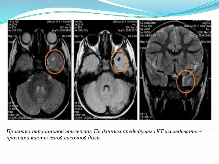 Признаки парциальной эпилепсии. По данным предыдущего КТ исследования – признаки кисты левой височной доли.