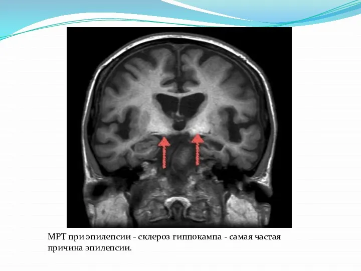 МРТ при эпилепсии - склероз гиппокампа - самая частая причина эпилепсии.