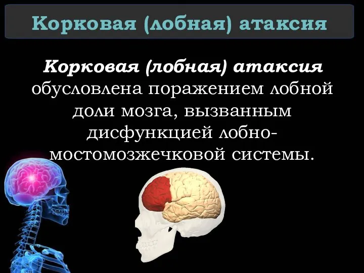 Корковая (лобная) атаксия Корковая (лобная) атаксия обусловлена поражением лобной доли мозга, вызванным дисфункцией лобно-мостомозжечковой системы.